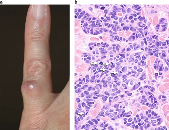 Merkel cell carcinoma: clinical and microscopic
