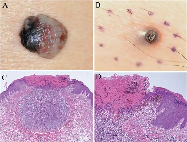Metastatic melanoma clinical and histological views