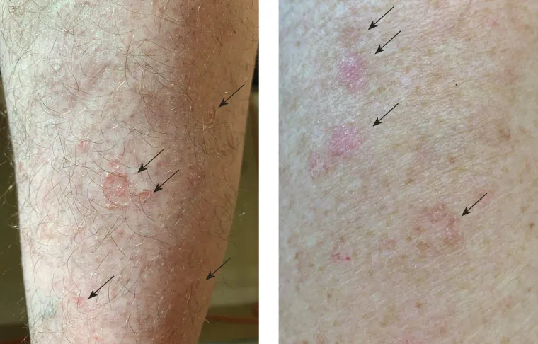 Actinic keratosis lesions on skin