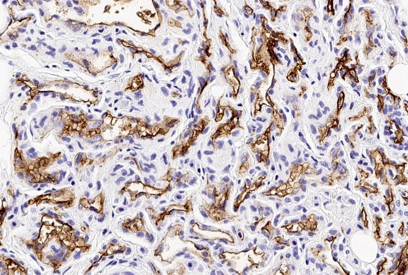 Infantile Hemangioma GLUT1 positive histology