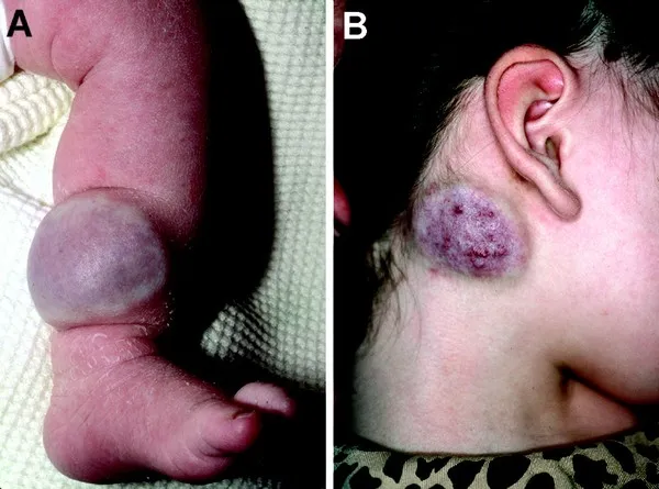 Vascular Tumors and Malformations