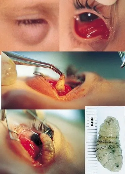 Surgical removal of Myiasis larva from eyelid