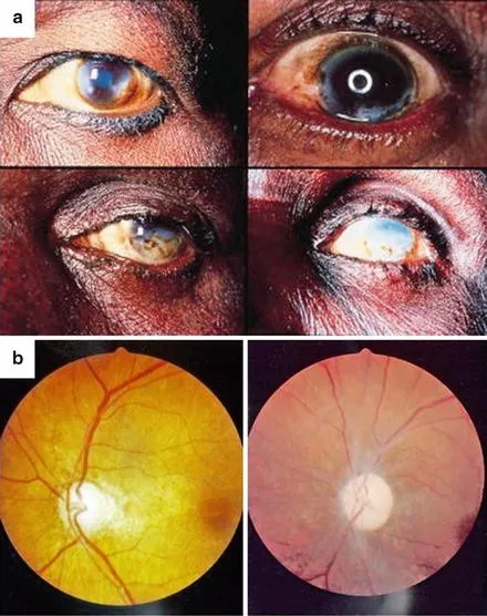 Ocular manifestations of Onchocerciasis