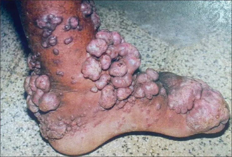 Chromoblastomycosis cauliflower lesions