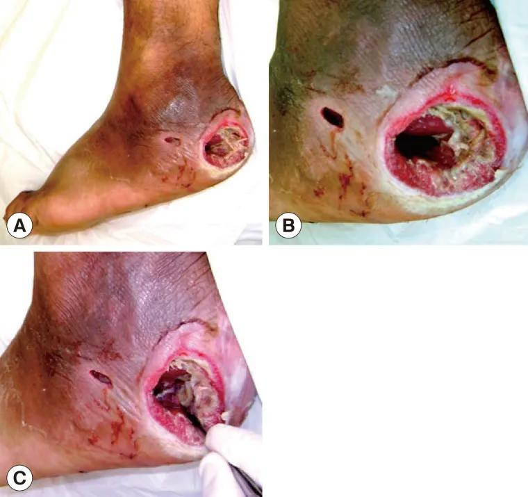 Tropical ulcer on lower limb
