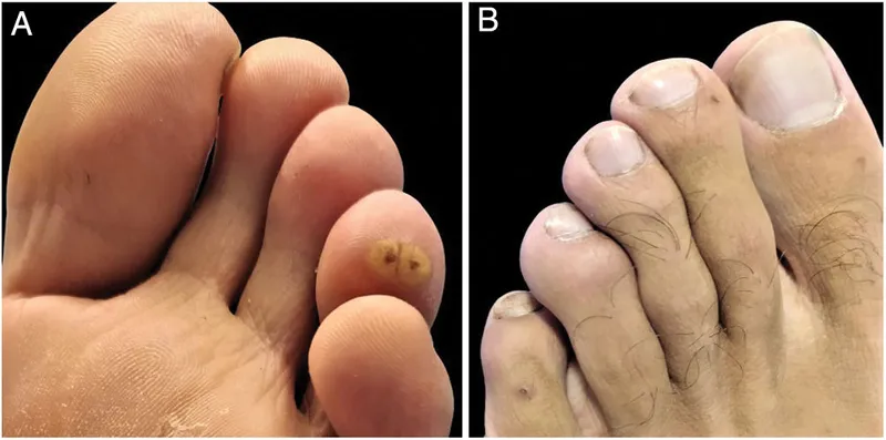 Tungiasis lesions on foot with central black dots