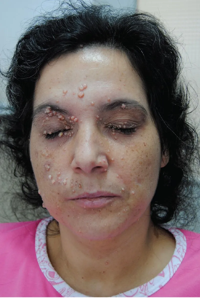 Giant molluscum contagiosum lesions on face