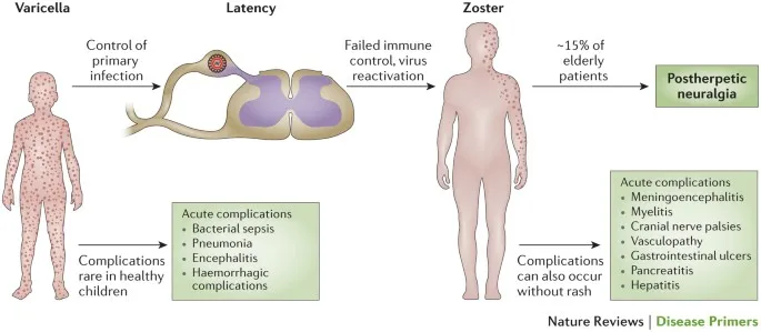 VZV: Varicella, Latency, and Zoster