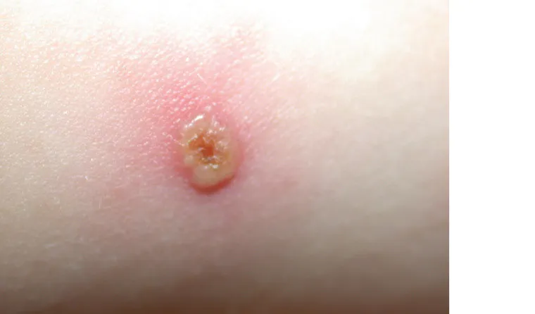 Chickenpox lesion, "dew drop on a rose petal"