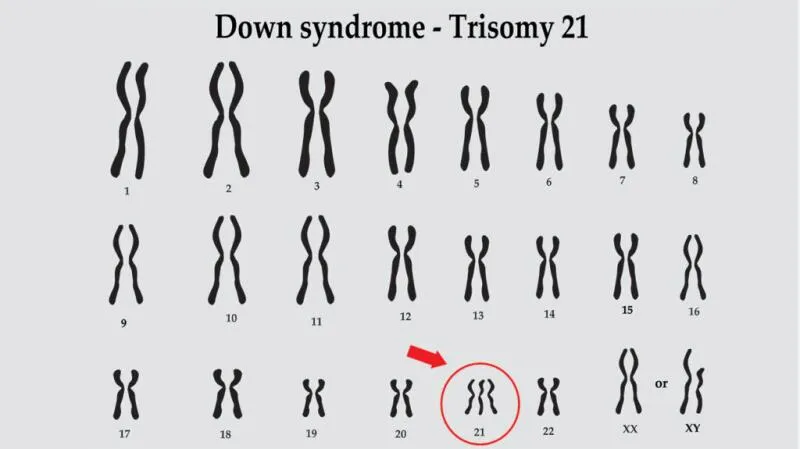 Karyotype of Down Syndrome (Trisomy 21)