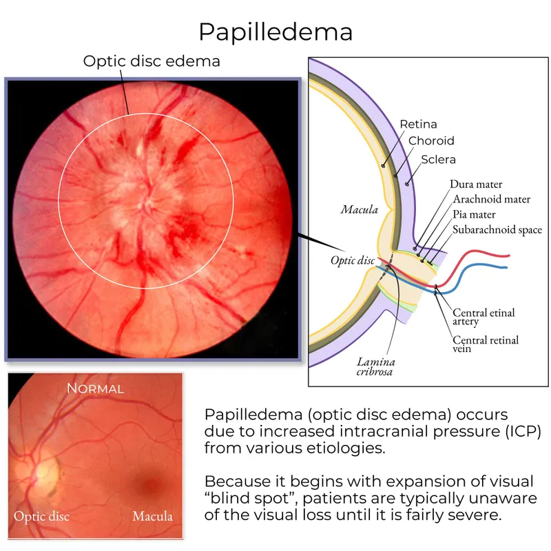 Papilledema: Fundoscopy, anatomy, and normal comparison