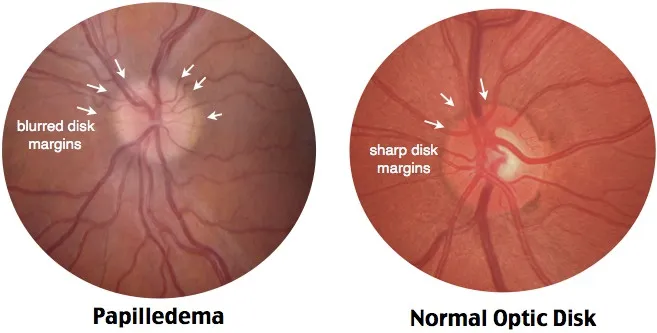 Papilledema vs. Normal Optic Disk