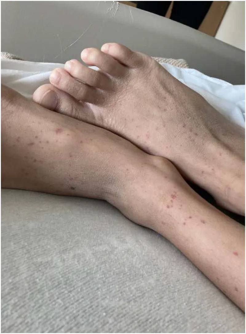 Palpable purpura on lower extremities