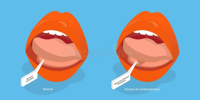 Normal vs. Tongue-tie (Ankyloglossia)