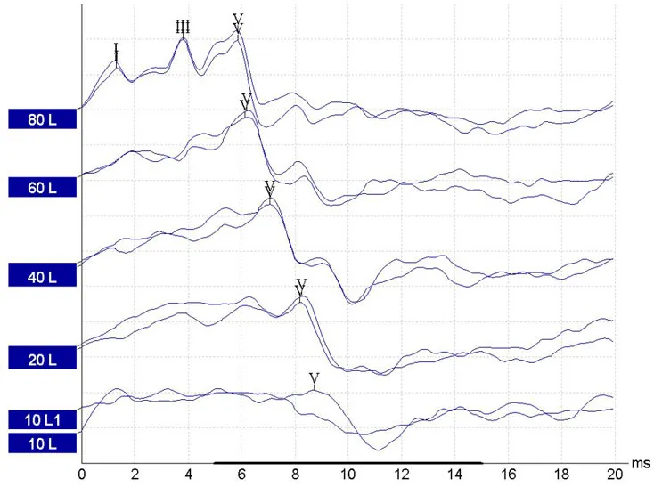 ABR Waveform Analysis