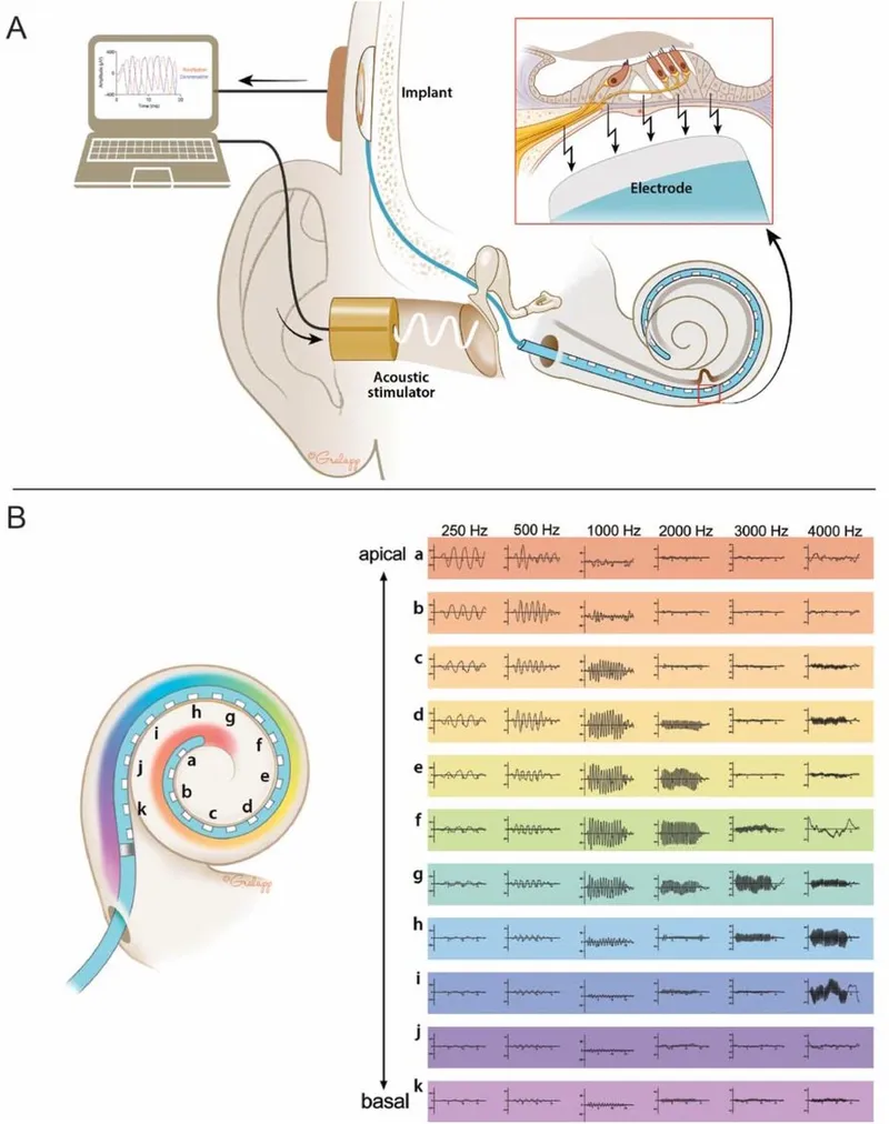 Cochlear implant placement and frequency mapping