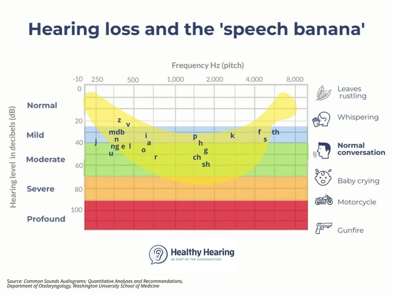Speech Banana Audiogram with Hearing Loss Levels