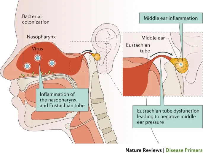 Acute Otitis Media Inflammation Pathway