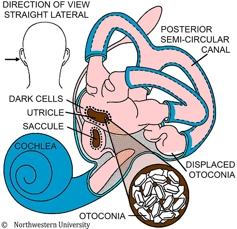 Inner ear anatomy and otoconia displacement in BPPV
