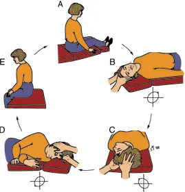 Epley Maneuver Steps Diagram