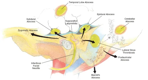 Pathways of COM complication spread