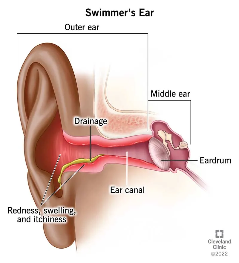 Swimmer's Ear (Otitis Externa) Diagram