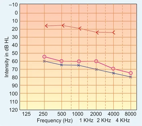 Audiogram showing conductive hearing loss