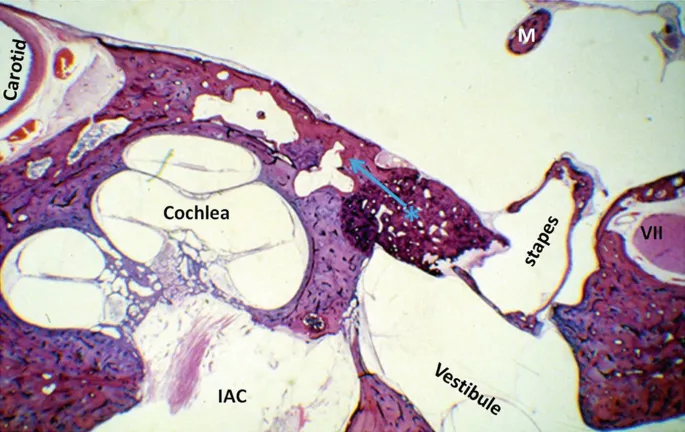 Otosclerosis histology, stapes footplate