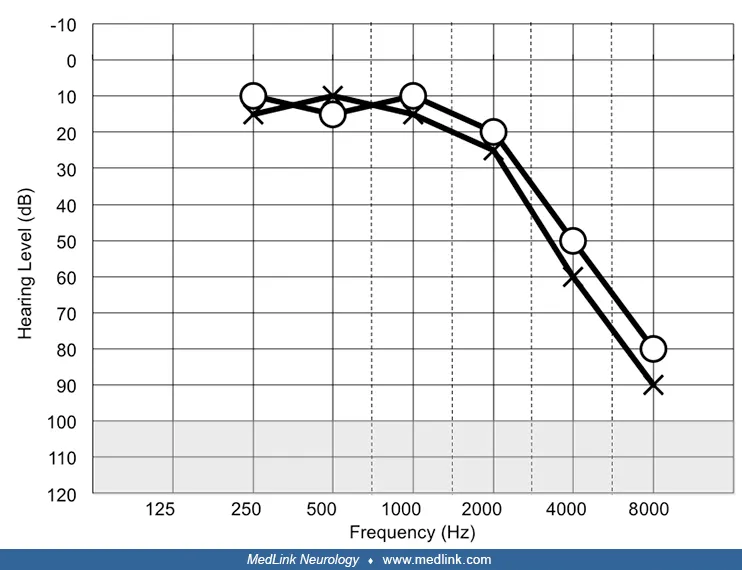 Audiogram: Bilateral Symmetrical High-Frequency Hearing Loss