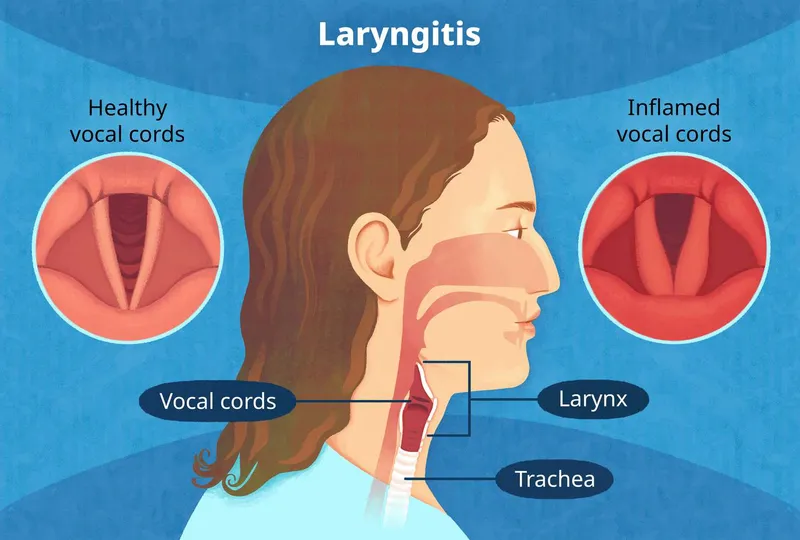 Healthy vs. inflamed vocal cords in laryngitis