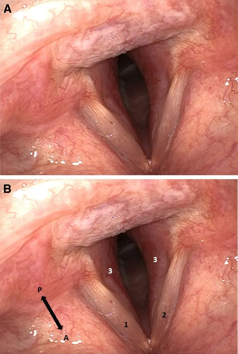 Laryngoscopic view of acute laryngitis