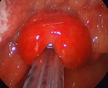 Cherry-red swollen epiglottis