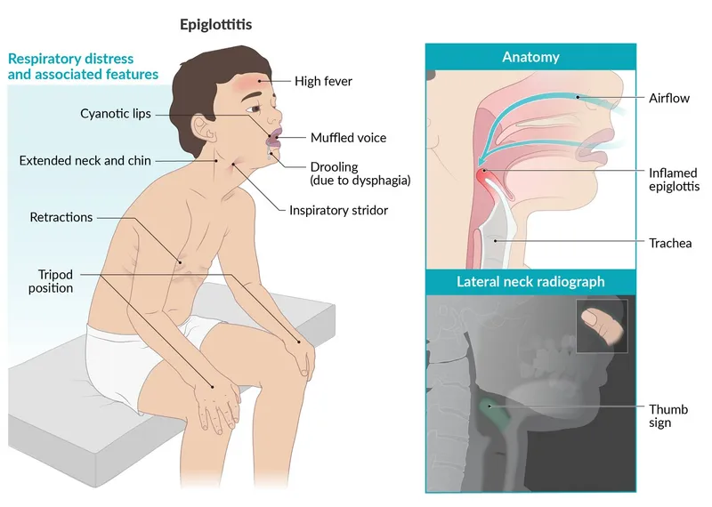 Epiglottitis symptoms, anatomy, and radiograph