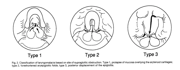 Laryngomalacia Classification Types