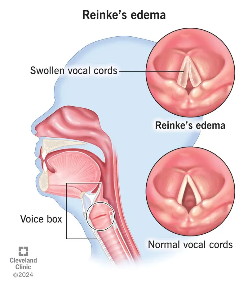 Reinke's Edema vs Normal Vocal Cords
