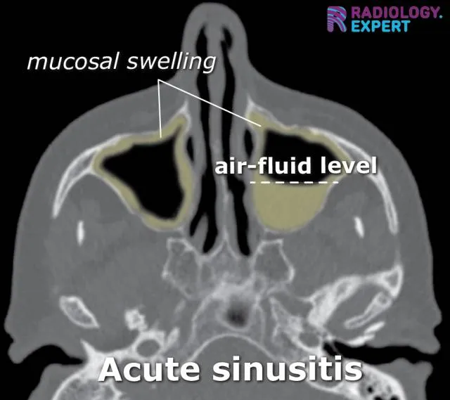 CT scan showing mucosal swelling and air-fluid level