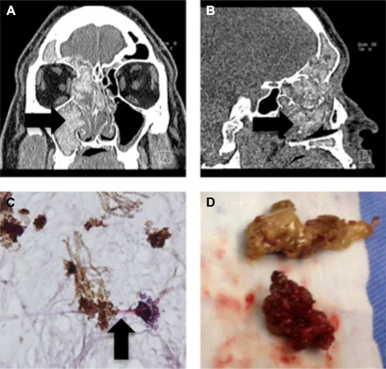 Allergic Fungal Sinusitis: CT, histology, gross