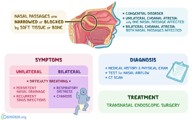 Choanal Atresia: Symptoms, Diagnosis, Treatment