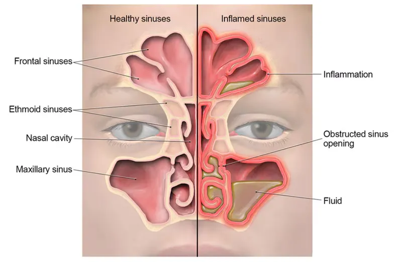 Healthy vs. Inflamed Sinuses