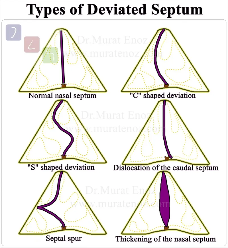 Types of Deviated Nasal Septum