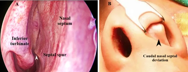 Deviated Nasal Septum: Spur and Caudal Deviation