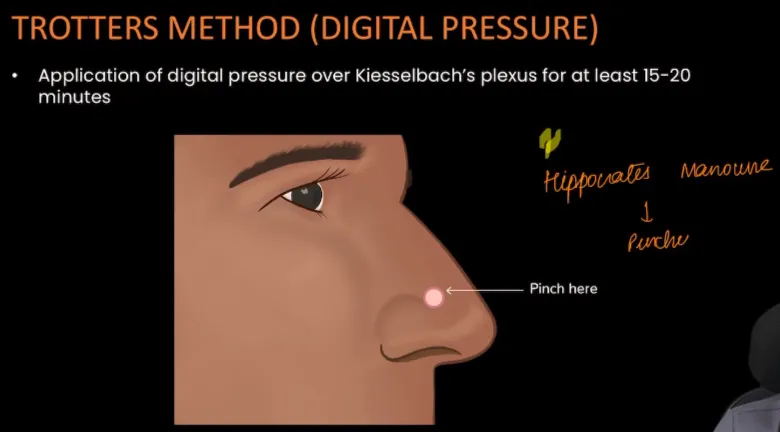 Trotter's Method for Epistaxis