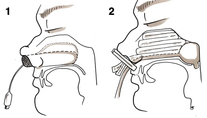 Anterior and posterior nasal packing for epistaxis