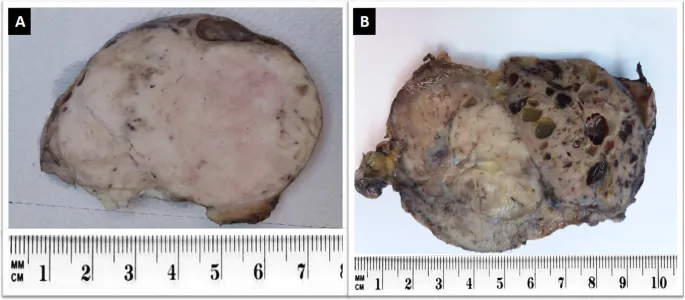 Gross appearance of malignant tumors of nose and sinuses