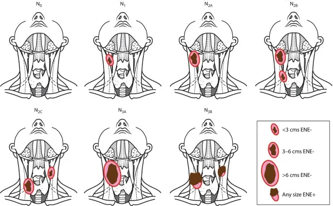 Oral Cancer N-Staging Diagram