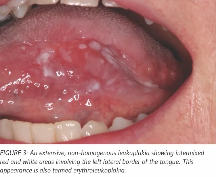 Erythroleukoplakia on tongue