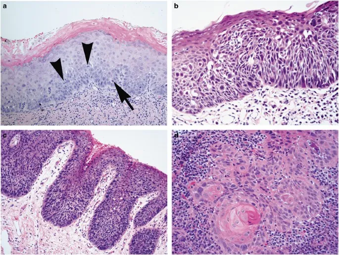 Oral Leukoplakia Histopathology with Dysplasia Grades