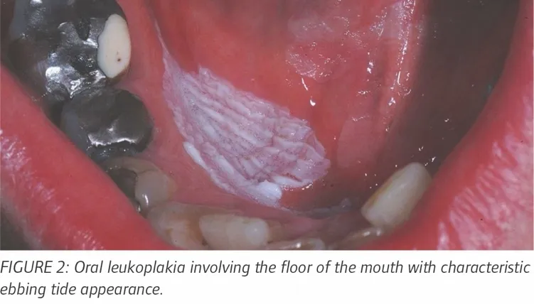 Oral leukoplakia on floor of mouth