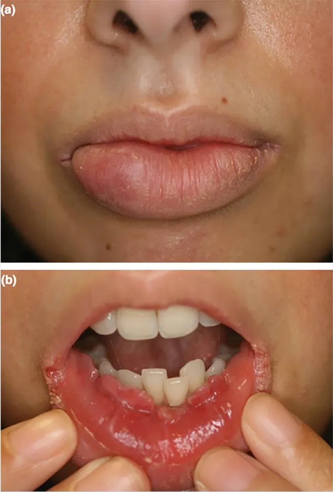 Oral manifestations of Crohn's disease