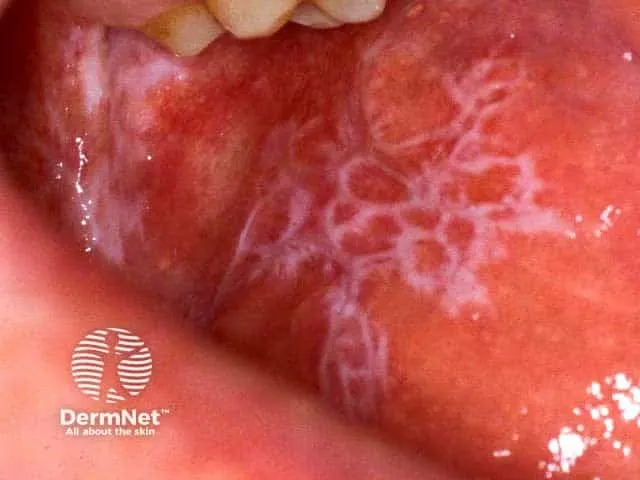 Oral Lichen Planus with Wickham's Striae
